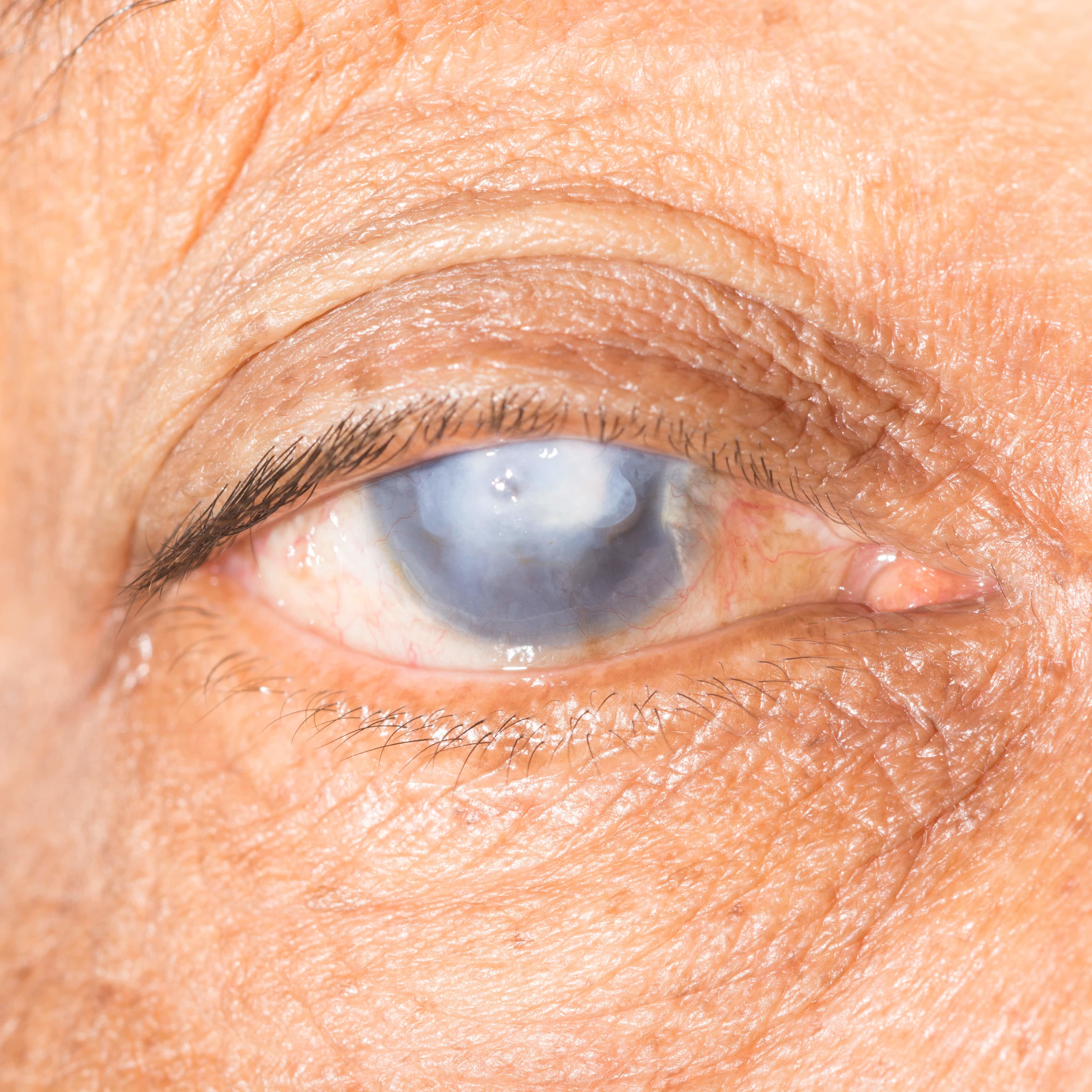 Glaucoma close up