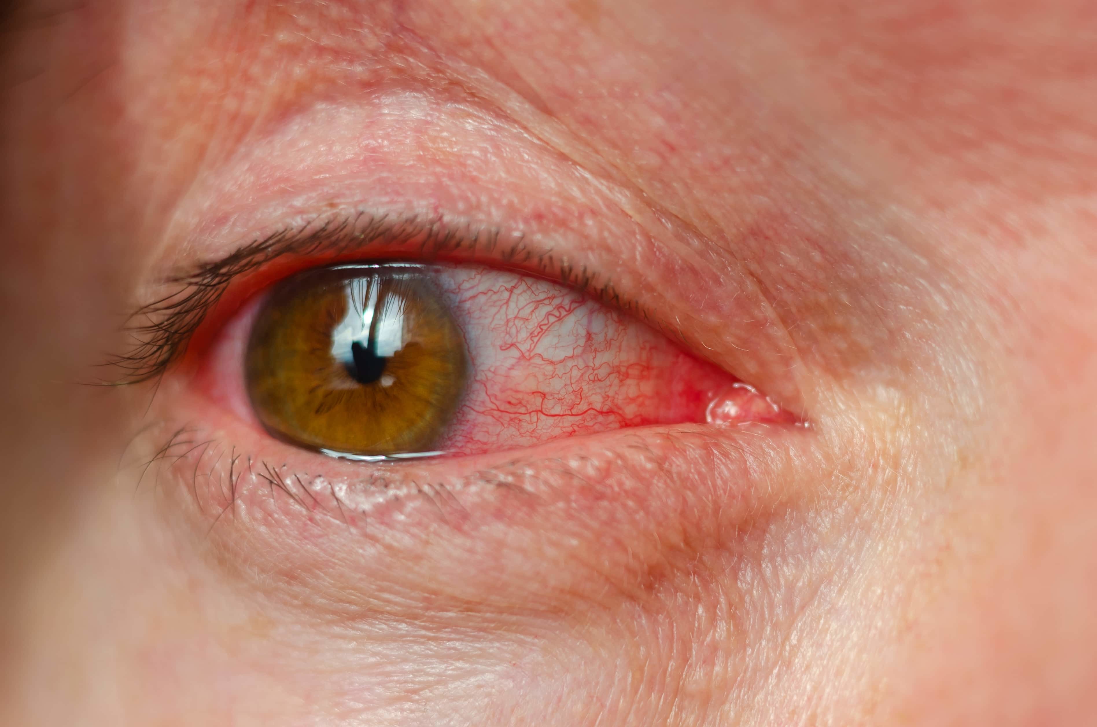 Red eye close up